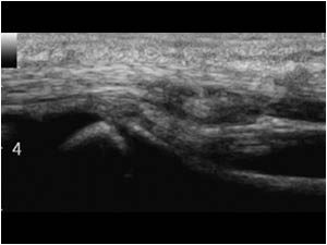 Retraction of the tendon proximal to the MCP joint