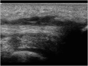 Tenosynovitis of the distal posterior tibial tendon longitudinal
