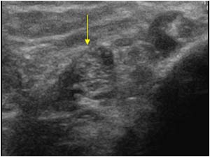 Thickened tibial nerve transverse