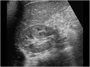 Abdominal and retroperitoneal tumors in infants
