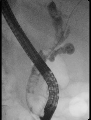 Gallstones in the extrahepatic bile ducts