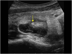 Abscess formation at the tip
