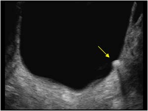 Small mobile calculus in the bladder