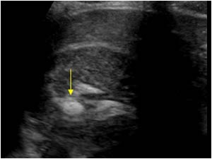 Stone in the upperpole of the right kidney
