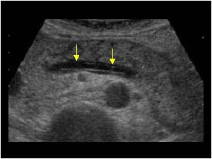 Demarcation of the splenic vein by extrapancreatic soft tissue edema