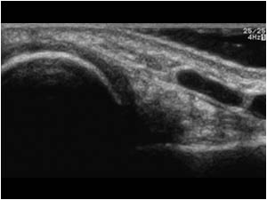 Dorsal displacement of the distal ulna transverse