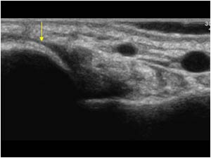 Dorsal displacement of the distal ulna transverse