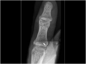 Traumatic lesions of the ulnar collateral ligament of the thumb