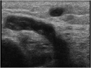 Thrombus extending in a perforating vein