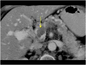 Case of the month August 2007: Tumor thrombus in the portal vein