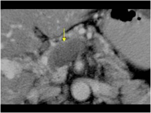 Case of the month August 2007: Tumor thrombus in the portal vein