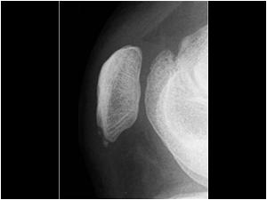 Fragmentation of the lowerpole of the patella