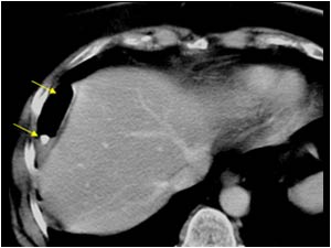Retained gallstone and perihepatic abscess