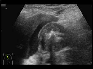 Thickened antral wall transverse