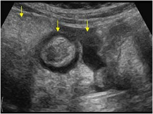 Omental infiltration, colon wall thickening and ascites