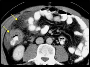 Omental infiltration and colon wall thickening