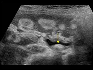 Right kidney with pelvic stone longitudinal
