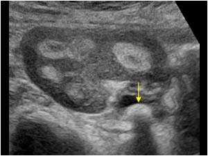 Right kidney with pelvic stone transverse