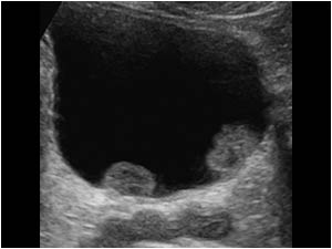 Multifocal bladder carcinoma