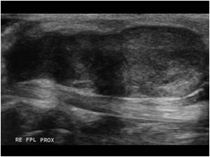 Palmar fibroma anterior of the flexor pollicis longus tendon longitudinal