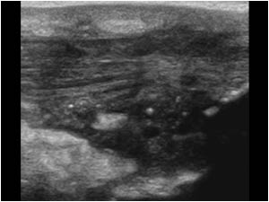 Deep infrapatellar bursitis and tendinitis longitudinal