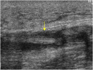 Retracted distal stump medial of the achilles tendon longitudinal