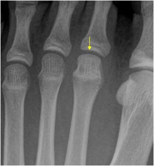 Initial X ray with normal contour of the second metatarsal bone