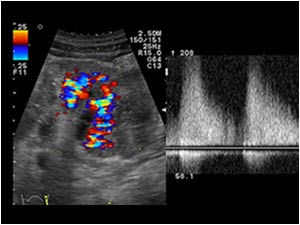 Thurbulent flow with high systolic velocities