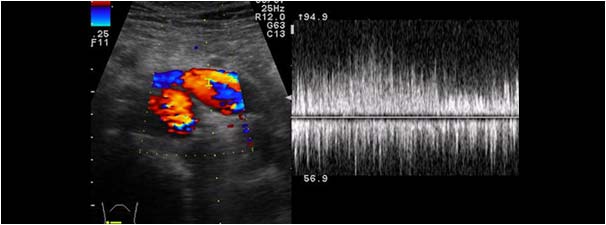 Turbulent flow in the renal vein
