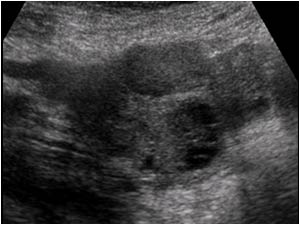 Ovarian carcinoma with a cystic ovarian mass