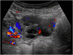 Ovarian carcinoma with a cystic ovarian mass