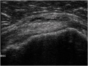 Thickened bursa anterior of the subscapularis tendon
