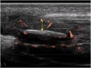 Vascularization around the wooden splinter longitudinal