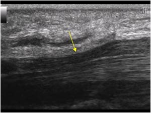Narrowing of the median nerve in the carpal tunnel longitudinal