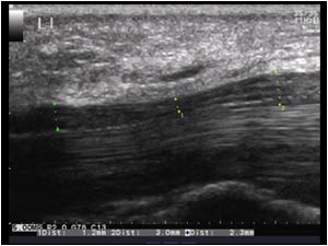Narrowing of the median nerve in the carpal tunnel longitudinal