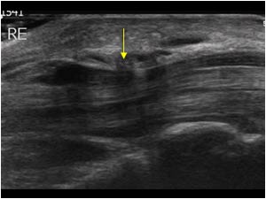 Narrowing of the right median nerve in the carpal tunnel longitudinal