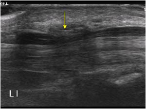 Narrowing of the left median nerve in the carpal tunnel longitudinal