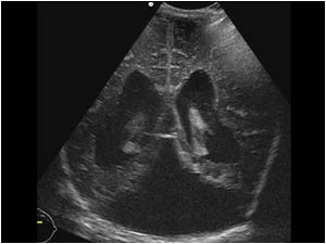 Dandy walker complex with dilatated ventricles and a posterior fossa cyst