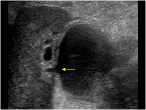 Gallbladder perforation and pericholecystitis