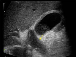 Dilatated cystic duct