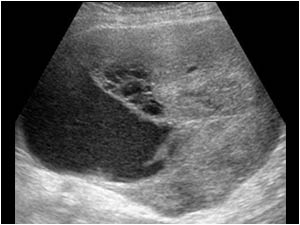 Ovarian carcinoma with a partly cystic mass