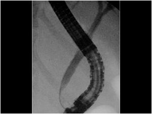An ERCP showed no stones in the common bile duct. A papillotomy was performed for a papil spasm.
