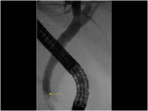 A repeated ERCP because of pain and increased liver function showed dilatation and a distal bile duct stone