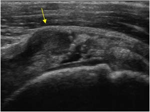 Bulging of the tendon caused by fluid trapped in the defect longitudinal