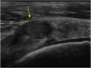 Bulging of the tendon caused by fluid trapped in the defect transverse