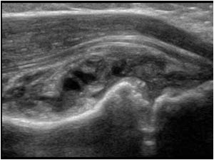 Synovial thickening and effusion in the annular recess longitudinal