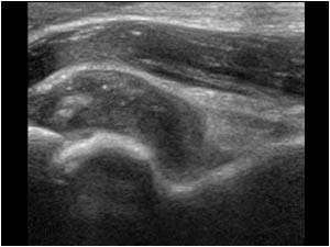 Synovial thickening and effusion in the coronoid fossa longitudinal