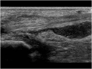 Extensor carpi ulnaris tendon longitudinal