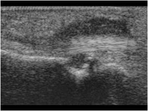 Vascular leimyoma and flexor tendon longitudinal