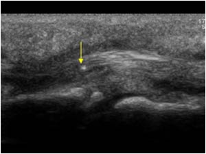 Tip of the wooden splinter and tenosynovitis of the flexor tendons longitudinal